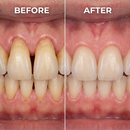 RetroSmile™ Advanced Teeth Repair Gel